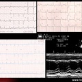 Atteinte cardiaque des rhumatismes inflammatoires