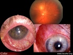 Polyarthrite rhumatoïde : atteinte de l'oeil