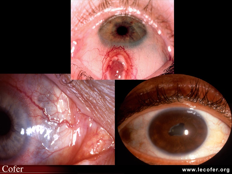Atteintes ophtalmiques de la polyarthrite rhumatoïde : sclérite perforante, scléromalacie, iritis. 020103034.jpg