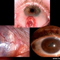 Polyarthrite rhumatoïde : atteinte de l'oeil