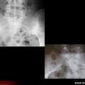 Spondylarthrite ankylosante / SpA / pelvispondylite rhumatismale / spondylarthropathie