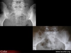 Spondylarthrite ankylosante / SpA / pelvispondylite rhumatismale / spondylarthropathie