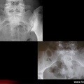 Spondylarthrite ankylosante / SpA / pelvispondylite rhumatismale / spondylarthropathie