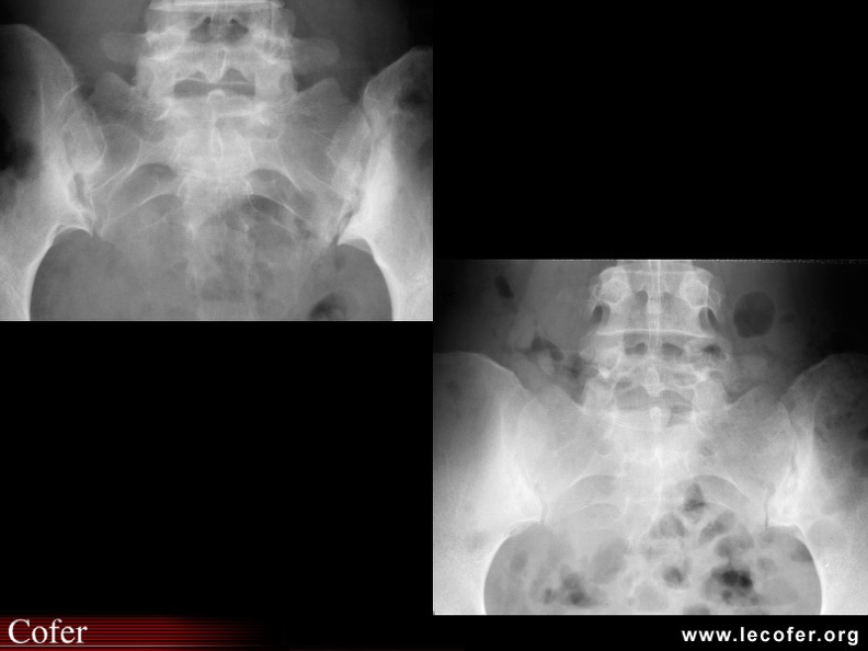 Spondylarthrite ankylosante/ SpA/ pelvispondylite rhumatismale / spondylarthropathie : Comparaison des sacro-iliites de stade 2 et 3. 020202006.jpg