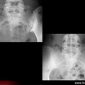 Spondylarthrite ankylosante / SpA / pelvispondylite rhumatismale / spondylarthropathie