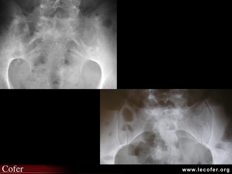 Spondylarthrite ankylosante / SpA / pelvispondylite rhumatismale / spondylarthropathie : Comparaison des sacro-iliites de stade 4 versus sacro-iliaques normales.
Spondylarthrite ankylosante / SpA/ pelvispondylite rhumatismale / spondylarthropathie : Comparaison de sacro-iliites de stade 4 (fusion des deux sacro-iliaques) bilatérales, et de sacro-iliaques normales. 020202008.jpg