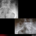 Spondylarthrite ankylosante / SpA / pelvispondylite rhumatismale / spondylarthropathie