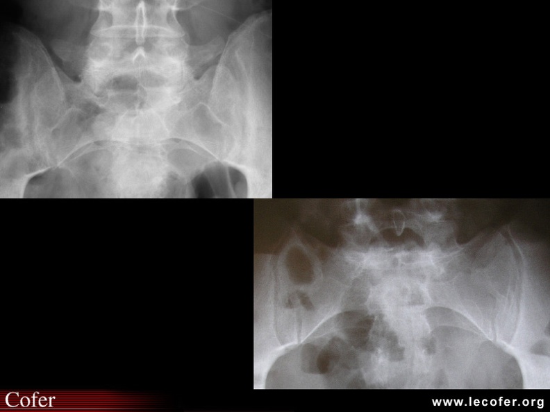 Spondylarthrite ankylosante / SpA / pelvispondylite rhumatismale / spondylarthropathie : Aspects de la sacro-iliite douteuse radiologiquement (stade 1).
Spondylarthrite ankylosante / SpA / pelvispondylite rhumatismale / spondylarthropathie : Comparaison de sacro-iliites de stade 1 (sacro-iliites douteuses) bilatérales et de sacro-iliaques normales. 020202010.jpg