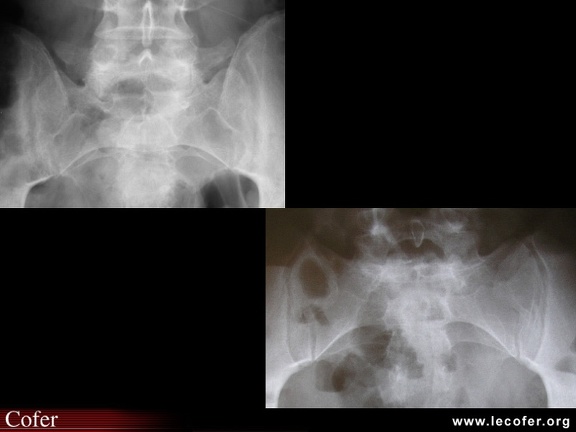 Spondylarthrite ankylosante / SpA / pelvispondylite rhumatismale / spondylarthropathie