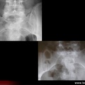 Spondylarthrite ankylosante / SpA / pelvispondylite rhumatismale / spondylarthropathie