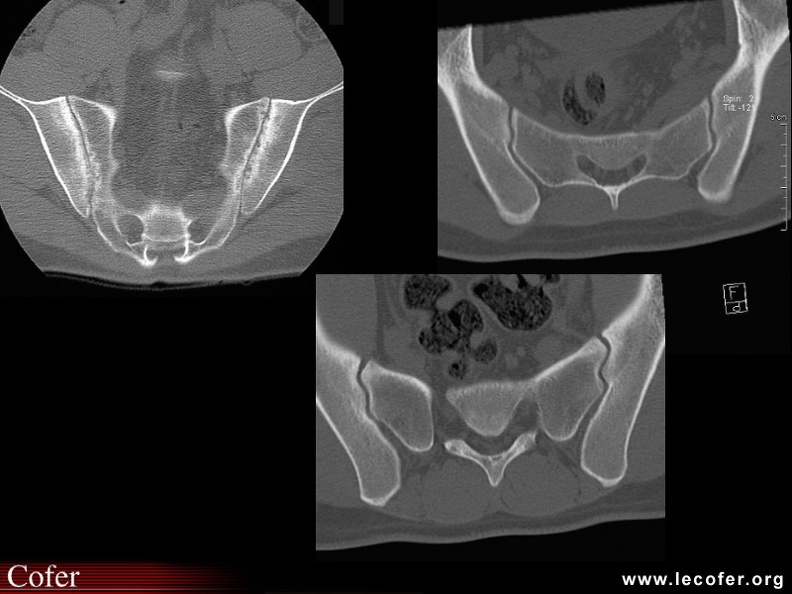 Spondylarthrite ankylosante / SpA / pelvispondylite rhumatismale / spondylarthropathie : Outils disponibles devant une sacro-iliite douteuse radiologiquement (stade 1) : (1) apport de la tomodensitométrie.
Spondylarthrite ankylosante / SpA / pelvispondylite rhumatismale / spondylarthropathie : Outils disponibles devant une sacro-iliite douteuse radiologiquement (stade 1) : Scanner de sacro-iliite débutante, versus scanner de sacro-iliaque normal (013 : partie haute de la sacro-iliaque ; 013 bis : partie basse de la sacro-iliaque). 020202012.jpg