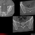 Spondylarthrite ankylosante / SpA / pelvispondylite rhumatismale / spondylarthropathie