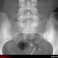 Spondylarthrite ankylosante / SpA / pelvispondylite rhumatismale / spondylarthropathie : Diagnostic différentiel