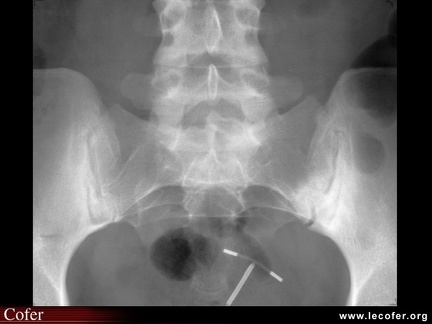 Spondylarthrite ankylosante / SpA / pelvispondylite rhumatismale / spondylarthropathie : Diagnostic différentiel