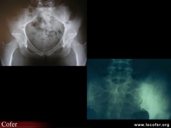 Spondylarthrite ankylosante / SpA / pelvispondylite rhumatismale / spondylarthropathie : Comparatif ostéose iliaque condensante