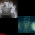 Spondylarthrite ankylosante / SpA / pelvispondylite rhumatismale / spondylarthropathie : Comparatif ostéose iliaque condensante