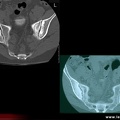 Spondylarthrite ankylosante / SpA / pelvispondylite rhumatismale / spondylarthropathie