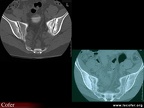 Spondylarthrite ankylosante / SpA / pelvispondylite rhumatismale / spondylarthropathie