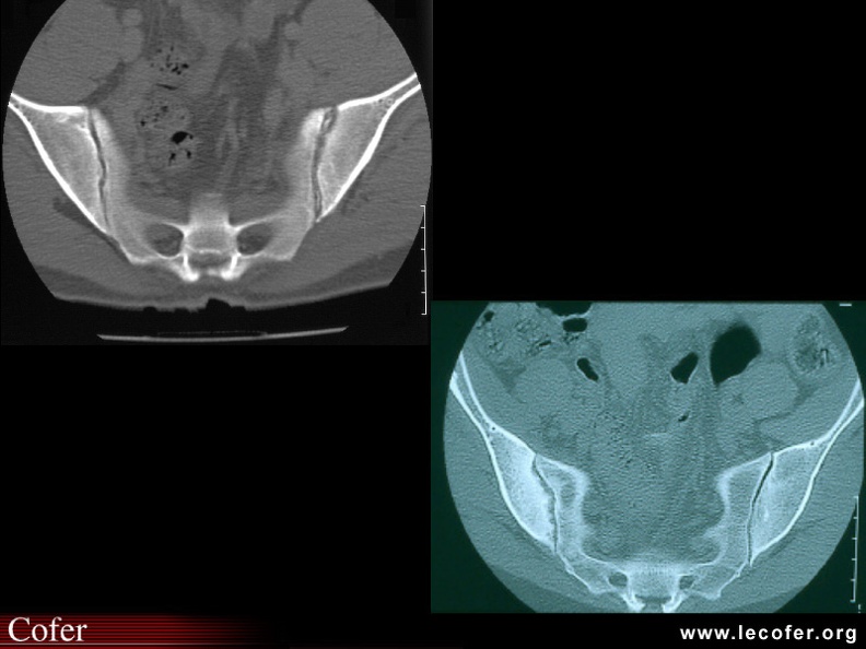 Spondylarthrite ankylosante / SpA / pelvispondylite rhumatismale / spondylarthropathie : Diagnostic différentiel