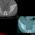 Spondylarthrite ankylosante / SpA / pelvispondylite rhumatismale / spondylarthropathie : Diagnostic différentiel