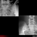 Spondylarthrite ankylosante / SpA / pelvispondylite rhumatismale / spondylarthropathie : diagnostic différentiel