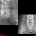 Spondylarthrite ankylosante / SpA / pelvispondylite rhumatismale / spondylarthropathie : diagnostic différentiel