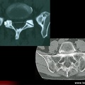 Spondylarthrite ankylosante / SpA / pelvispondylite rhumatismale / spondylarthropathie : Diagnostic différentiel