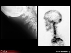 Spondylarthrite ankylosante / SpA / pelvispondylite rhumatismale / spondylarthropathie : enthésopathie de l’occiput