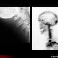 Spondylarthrite ankylosante / SpA / pelvispondylite rhumatismale / spondylarthropathie : enthésopathie de l’occiput