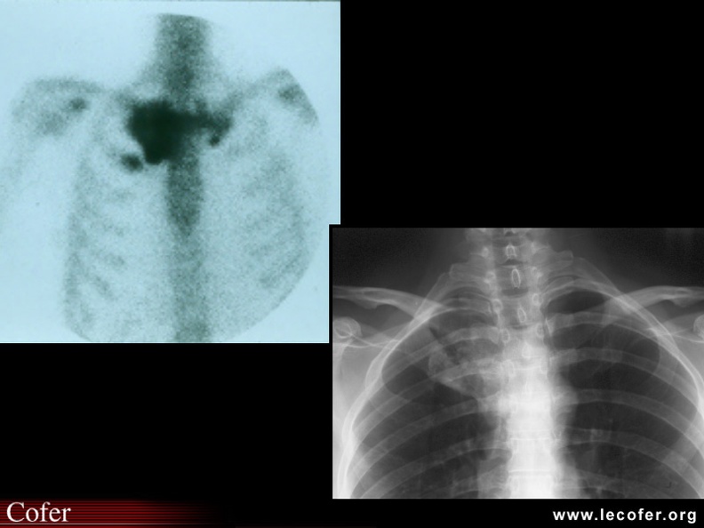 SAPHO : Scintigraphie du grill costal montrant une intense fixation de la sterno-claviculaire droite, mais aussi de l'extrémité antérieure de la première côte gauche et de la première côte droite (syndrome SAPHO). Radiographie correspondante : hyperostose de l'extrémité antérieure de la première côte droite venant rejoindre une hyperostose en provenance de la sterno-claviculaire droite. 020202089.jpg