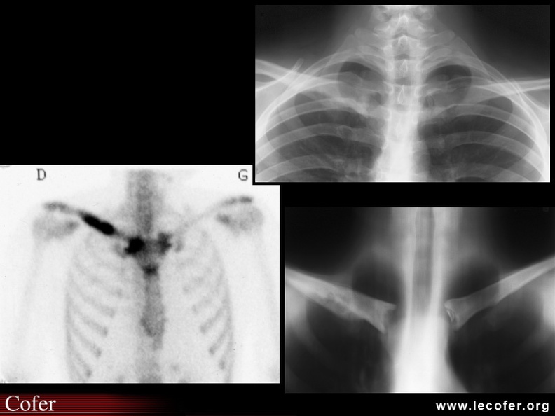 SAPHO : Scintigraphie et Radio + Tomographies de face (syndrome SAPHO) : ostéite aseptique de la clavicule droite (ostéite condensante et hypertrophiante), et arthrite des deux sterno-claviculaires, et de la manubrio-sternale. 020202090.jpg