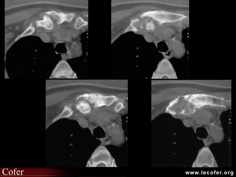 SAPHO : Coupes scanners de la jonction sterno-costo-claviculaire dans un syndrome SAPHO avec enthésopathies ossifiantes de la jonction entre sterno-claviculaire et première côte, mais aussi arthrite sterno-claviculaire, et ostéite de contiguïté du manubrium. 020202093.jpg