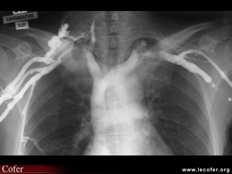 SAPHO : Répercussion sur le réseau veineux sous-clavier de l’hypertrophie de la clavicule induite par l'ostéite aseptique et hypertrophiante de la clavicule parfois notée dans le SAPHO. 020202094.jpg