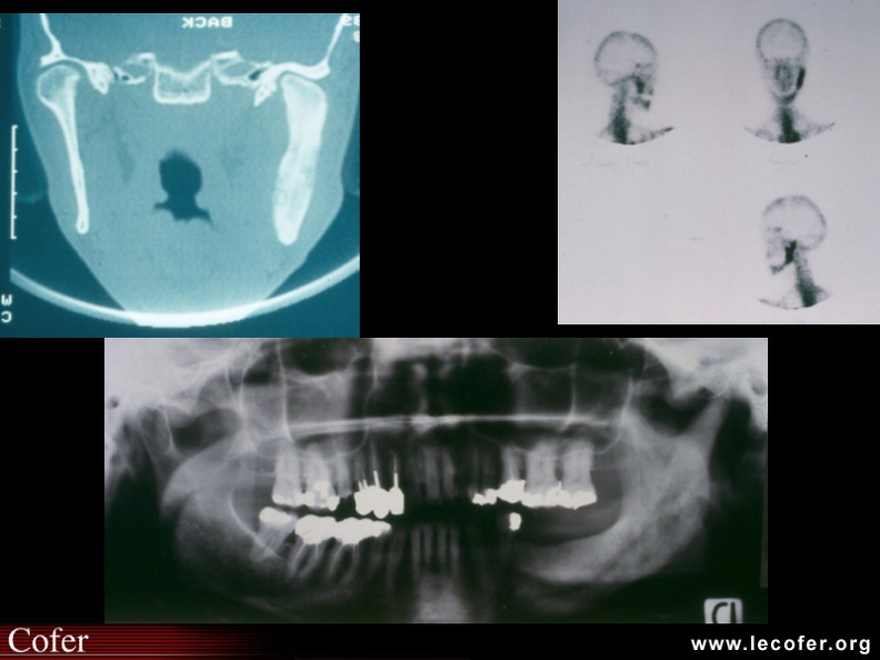 Ostéite condensante de la mandibule gauche dans le cadre d'un syndrome SAPHO : aspect radiographique (panoramique dentaire), scintigraphique, et scanner : comparer avec la mandibule droite, normale. 020202112.jpg