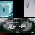 SAPHO : Ostéite mandibulaire de type SAPHO
