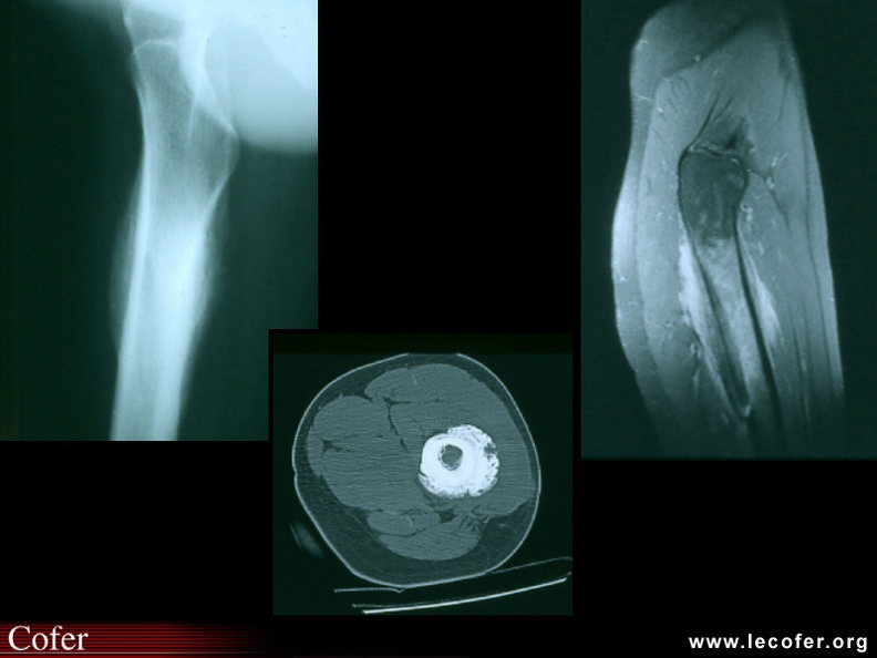 Ostéomyélite aseptique du fémur dans le contexte d'un SAPHO (précédant le diagnostic d'une maladie de Crohn) : aspect radiographique, IRM (séquence T2), et scanner : noter la périostose exubérante qui fait le tour du fût fémoral, et son association à une hyperostose (épaississement de la corticale). Le caractère évolutif de l'atteinte est attesté par la présence d'une inflammation au sein de la cavité médullaire (aspect d'hypersignal T2 en IRM, également noté sur le périoste). 020202114.jpg