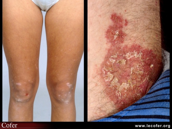 Psoriasis / Psoriasis cutané