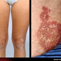 Psoriasis / Psoriasis cutané