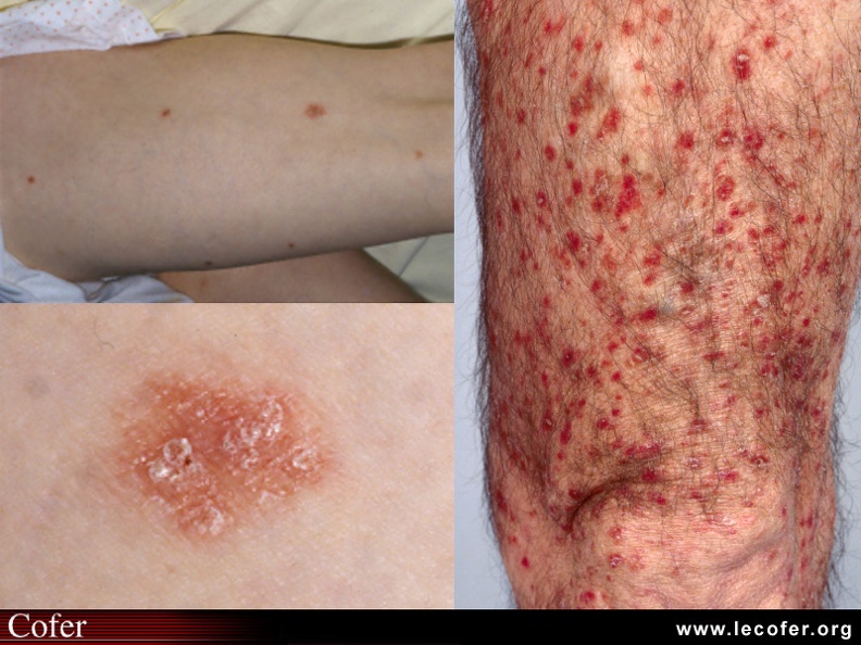 Psoriasis en goutte ou « guttata » (semis d'éléments sur l'ensemble ou une partie du corps : ici, les cuisses surtout) : vue d'ensemble, et détail d'un élément où l'on discerne bien les squames blanches sur fond érythémateux. Forme plus floride où les éléments tendent à confluer. 020203003.jpg