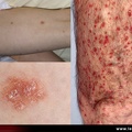 Psoriasis en gouttes ou psoriasis guttata