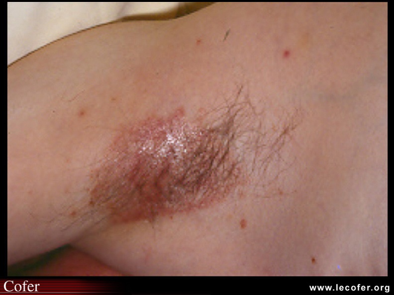 Psoriasis des plis (aisselle) : aspect d'intertrigo érythémateux aux bords nets. 020203004.jpg