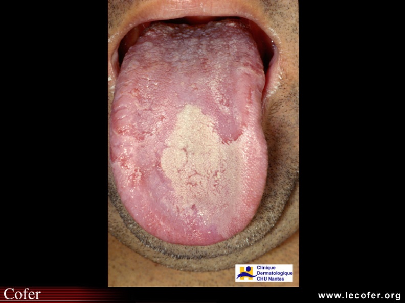 Psoriasis de la langue. 020203005s.jpg