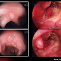 Maladie de Crohn  : aspects endoscopiques