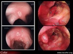 Maladie de Crohn  : aspects endoscopiques