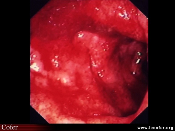 Rectocolite hémorragique : aspects endoscopiques