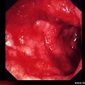 Rectocolite hémorragique : aspects endoscopiques