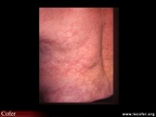 Lupus systémique, lupus érythémateux disséminé : manifestations cutanées d’origine vasculaire