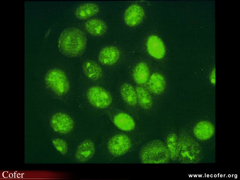 Lupus systémique, lupus érythémateux disséminé : anomalies immunologiques au cours du lupus systémique