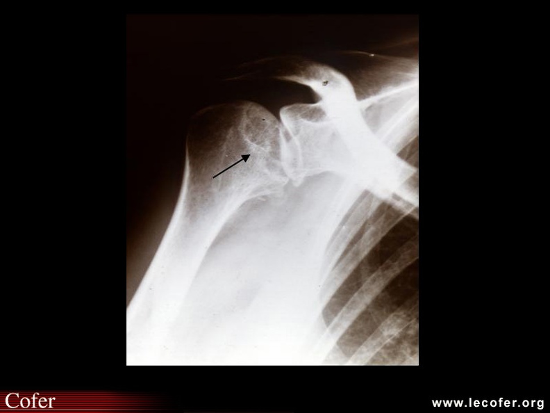 La radiographie du thorax est un examen essentiel pour diagnostiquer une atteinte pulmonaire ou cardiaque et en particulier les épanchements pleural et péricardique qui sont les manifestations les plus fréquentes. 020302011.jpg