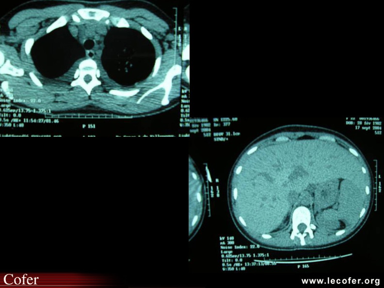 Les manifestations neurologiques sont variées : neuropsychiatriques en rapport plutôt avec une vascularite cérébrale ou des accidents vasculaires cérébraux en rapport plutôt à une thrombose cérébrale. 020302024.jpg